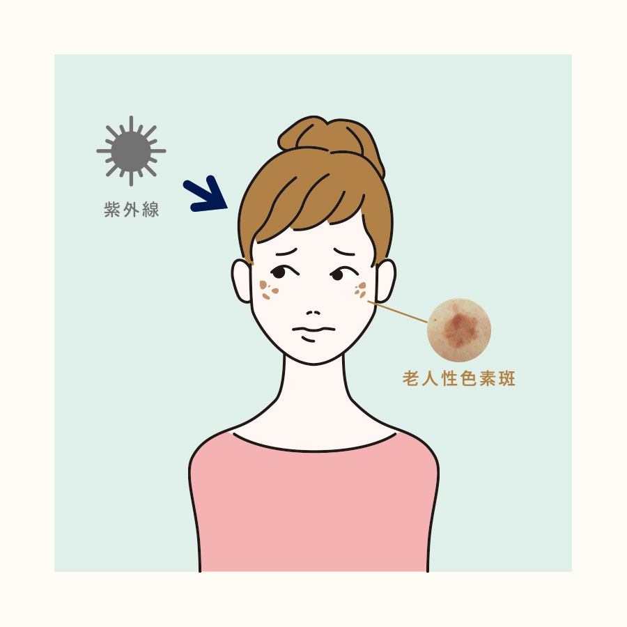 老人性色素斑 図解